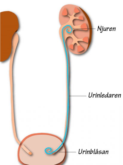 J-stent i njure